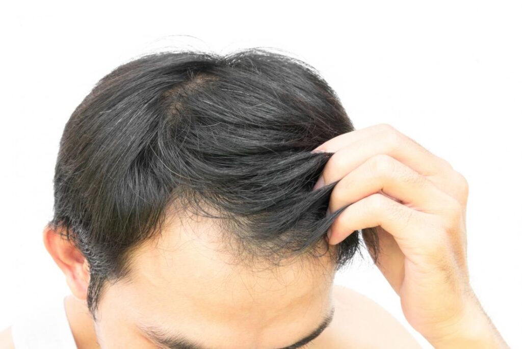 Homeopathic treatment for hair fall has always existed