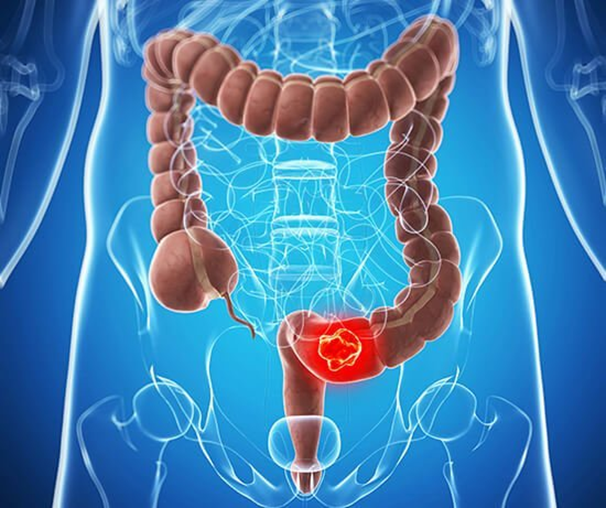 Diagnosing and Treating Colorectal Cancer