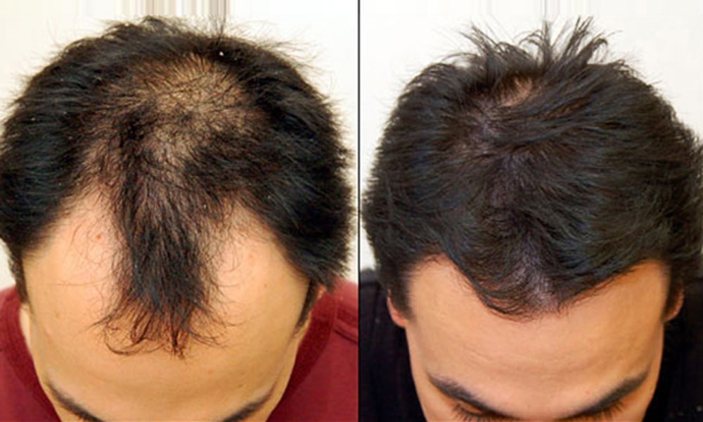 Hair Transplant Costs In Turkey - Factors That Influence Prices