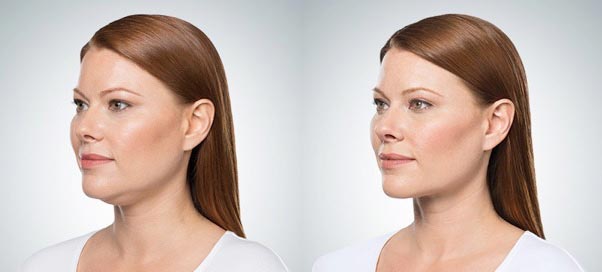 How Much Does a Chin Reduction Surgery Cost?