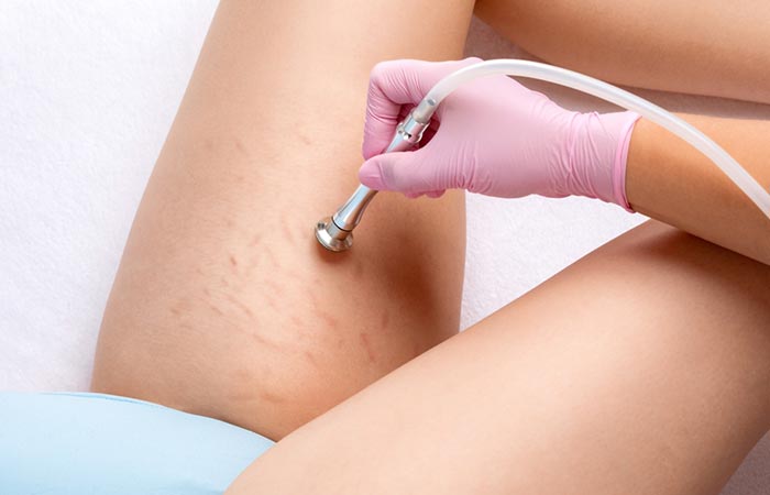 Can Laser Treatments Really Get Rid Of Stretch Marks?
