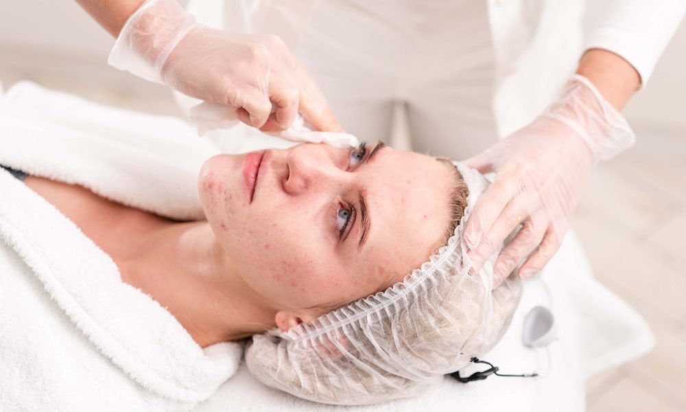 What is Acne Surgery? Understanding Procedures, Benefits, and Considerations